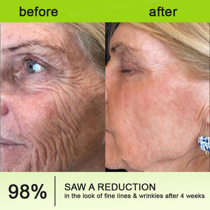 🇳🇿Made and shipped from the NZ 💥Rolimey® Botox & Vita-A Retinol Shot Wrinkle-Lift Tightening cream - Last Day Promotion 70% OFF
