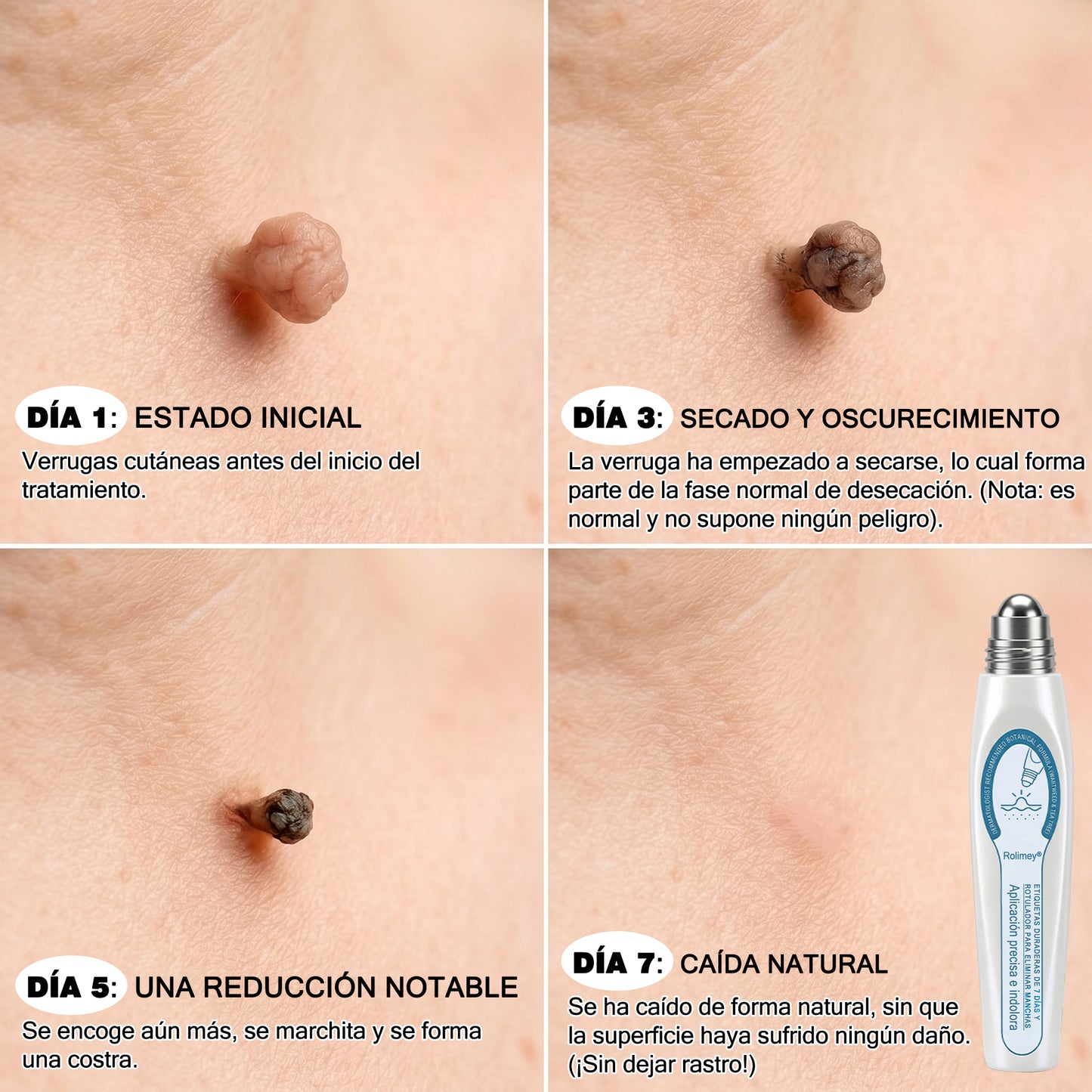 ✅Rolimey® Roll-on eliminador de verrugas cutáneas y manchas (tratamiento de 7 días)👩‍⚕️
